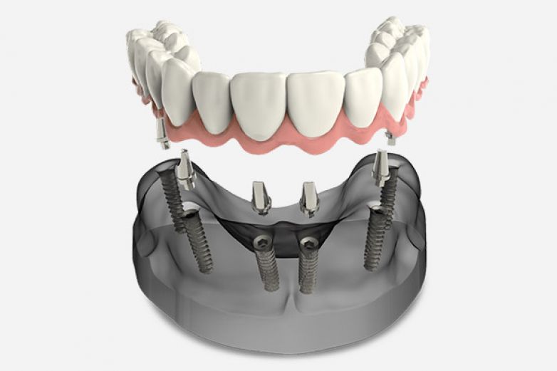 Протезирование зубов на 4 имплантах - что важно знать и где можно сделать